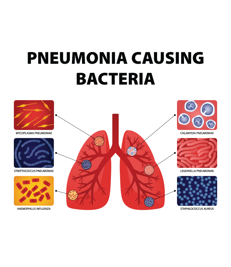 Root Causes of Demystifying Pneumonia