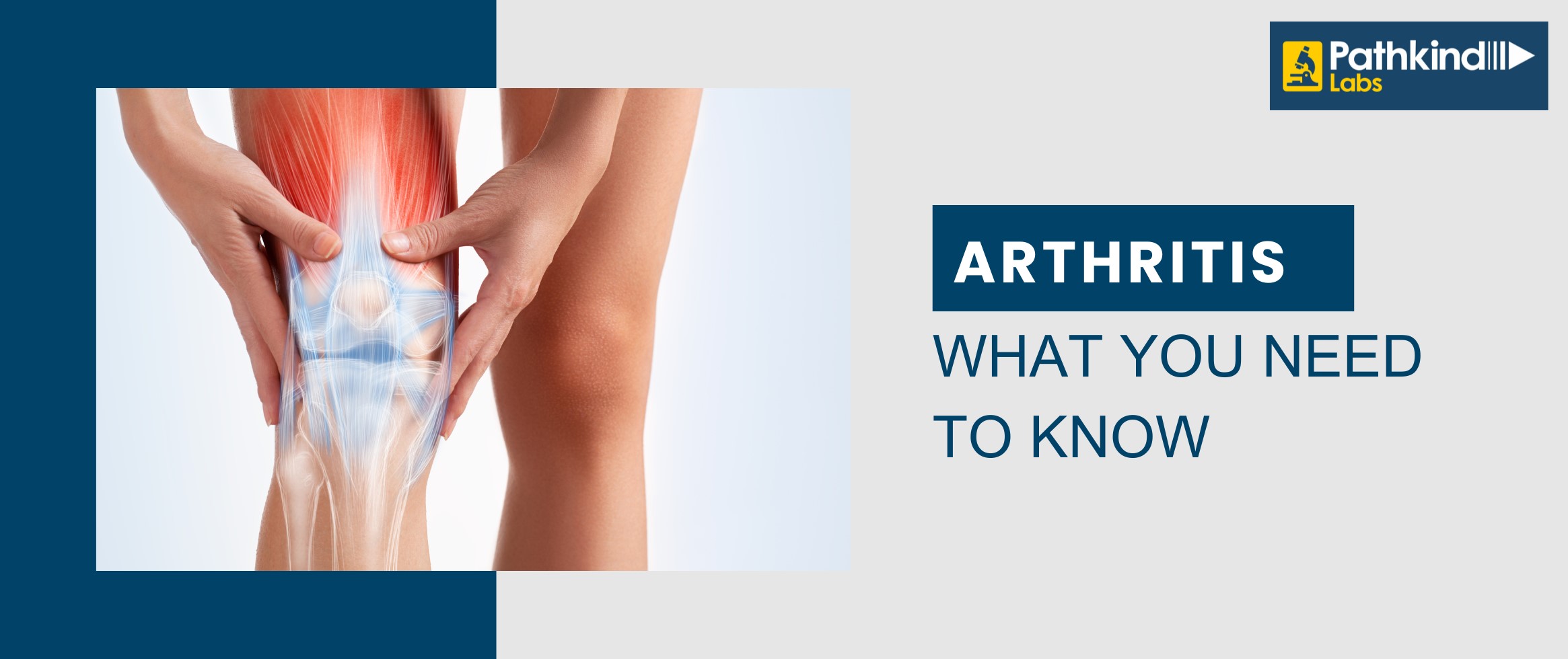 Arthritis- What is New