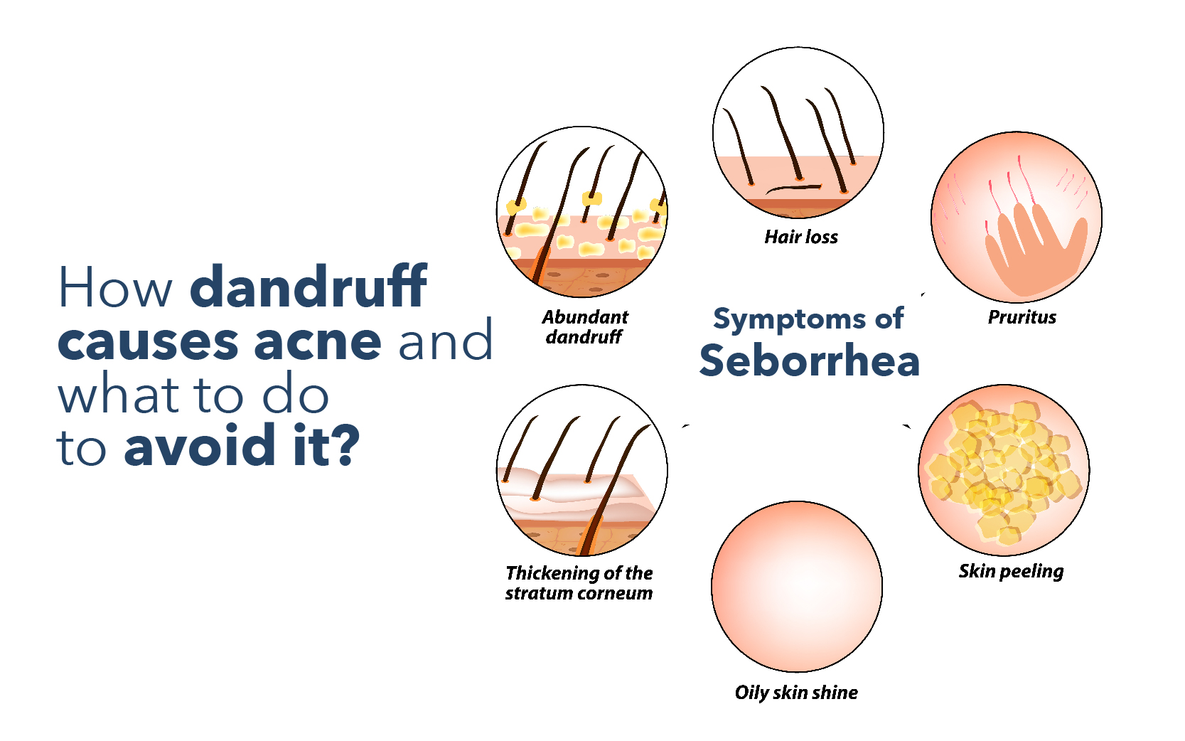 How Dandruff Causes Acne and What to Do to Avoid It