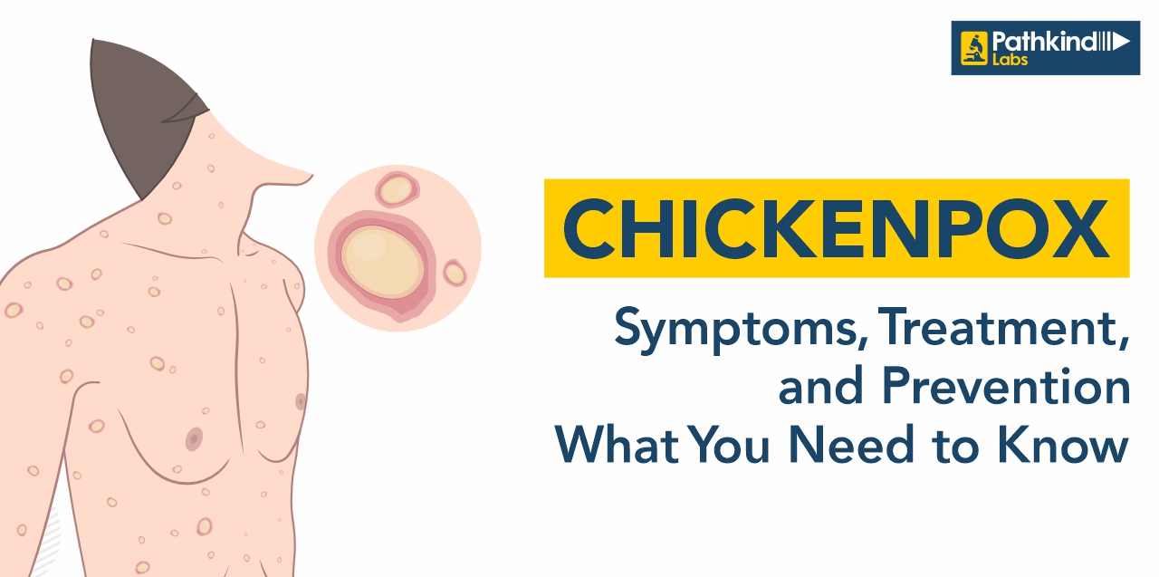 Chickenpox: Symptoms, Treatment, and Prevention