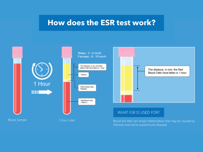 Decoding ESR Test