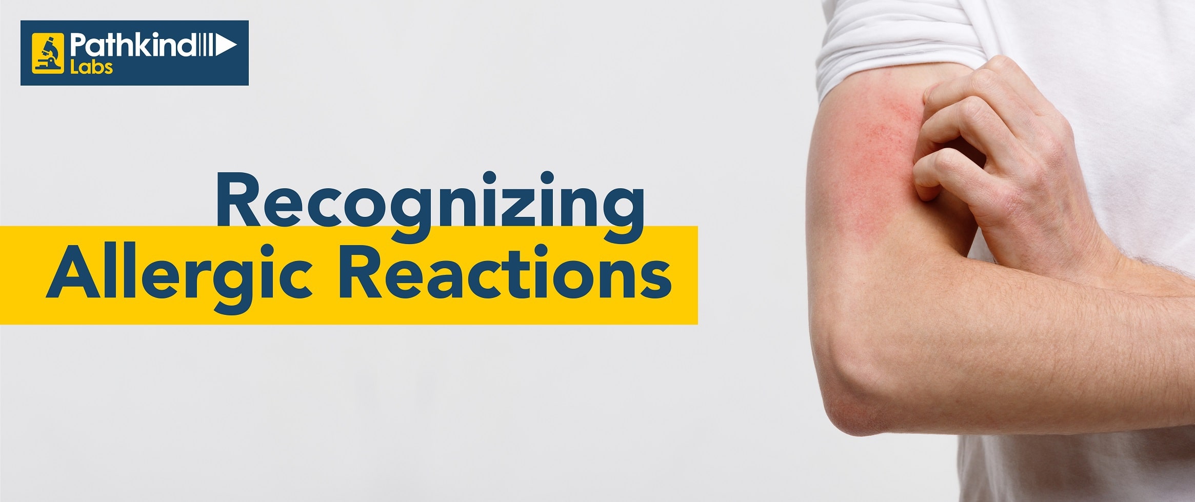 Recognizing Allergic Reactions: Unveiling Symptoms and Signs