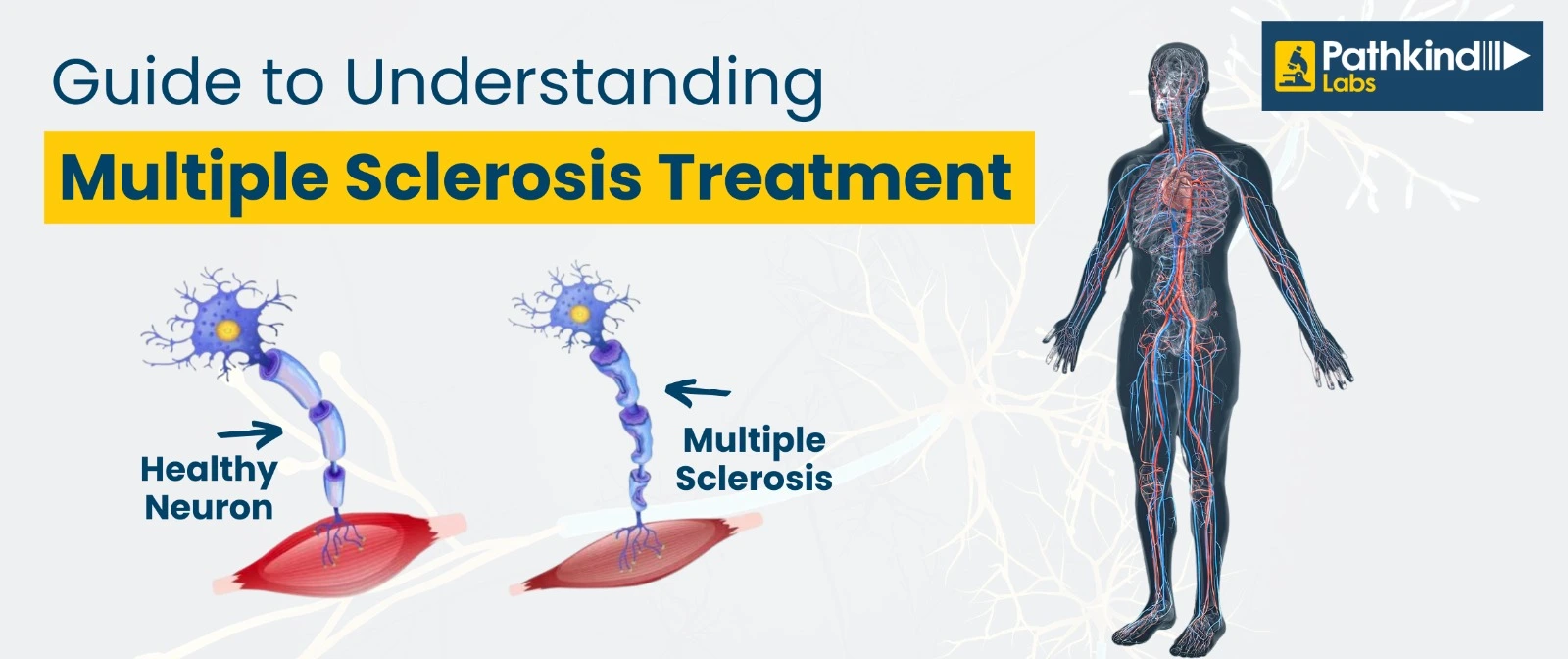 Understanding Multiple Sclerosis Treatment